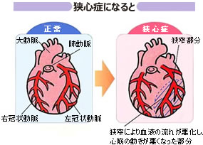 動脈硬化が心臓の血管に起こったら…虚血性心疾患（狭心症・心筋梗塞 ...