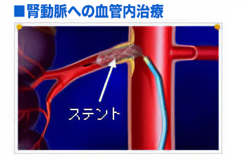 腎動脈への血管内治療